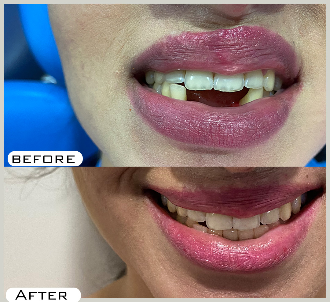 Dental Implants in Hyderabad India Focus Dental Care