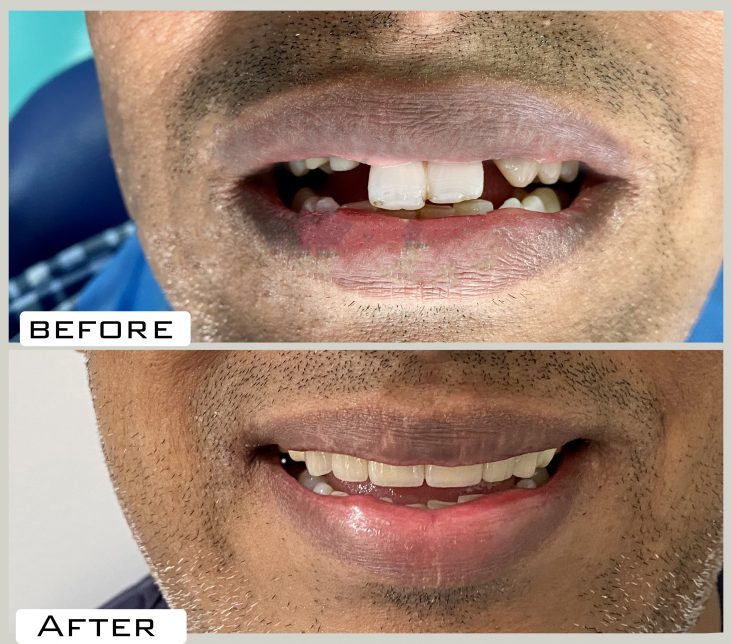 Dental Implants in Hyderabad India Focus Dental Care