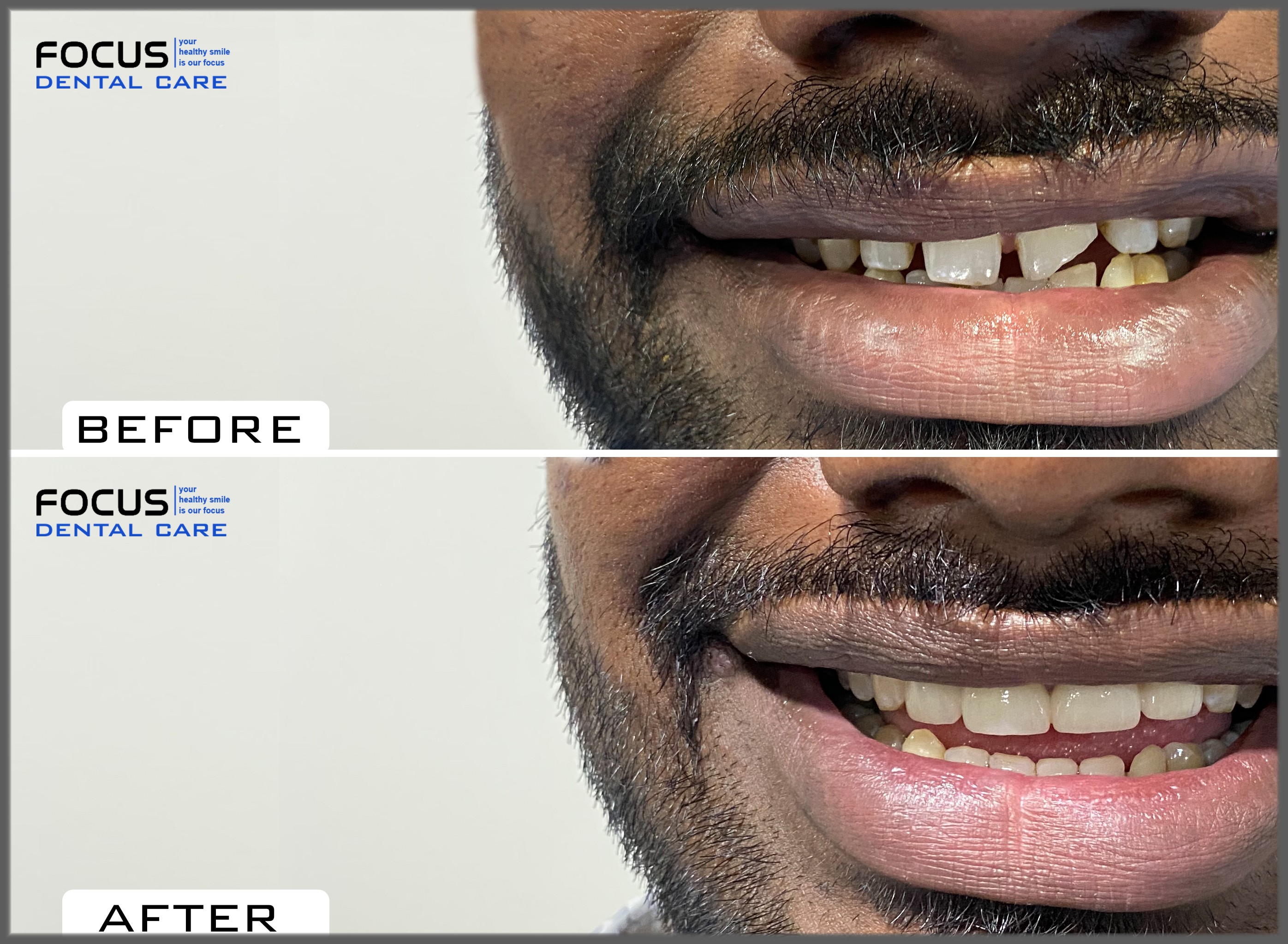 Dental Veneers in Hyderabad