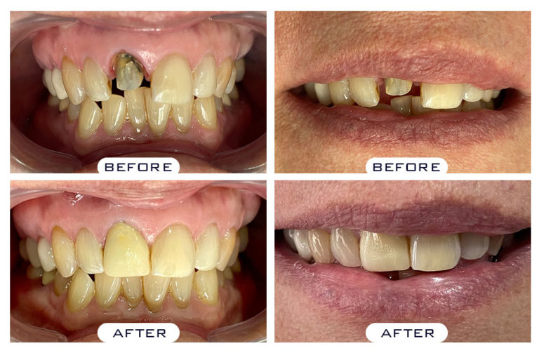 Dental Crowns Cost & Treatment in Hyderabad India Focus Dental Care