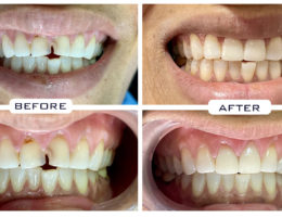 Dental Veneers Laminates in Hyderabad