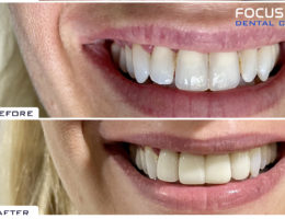 Dental Veneers in Hyderabad