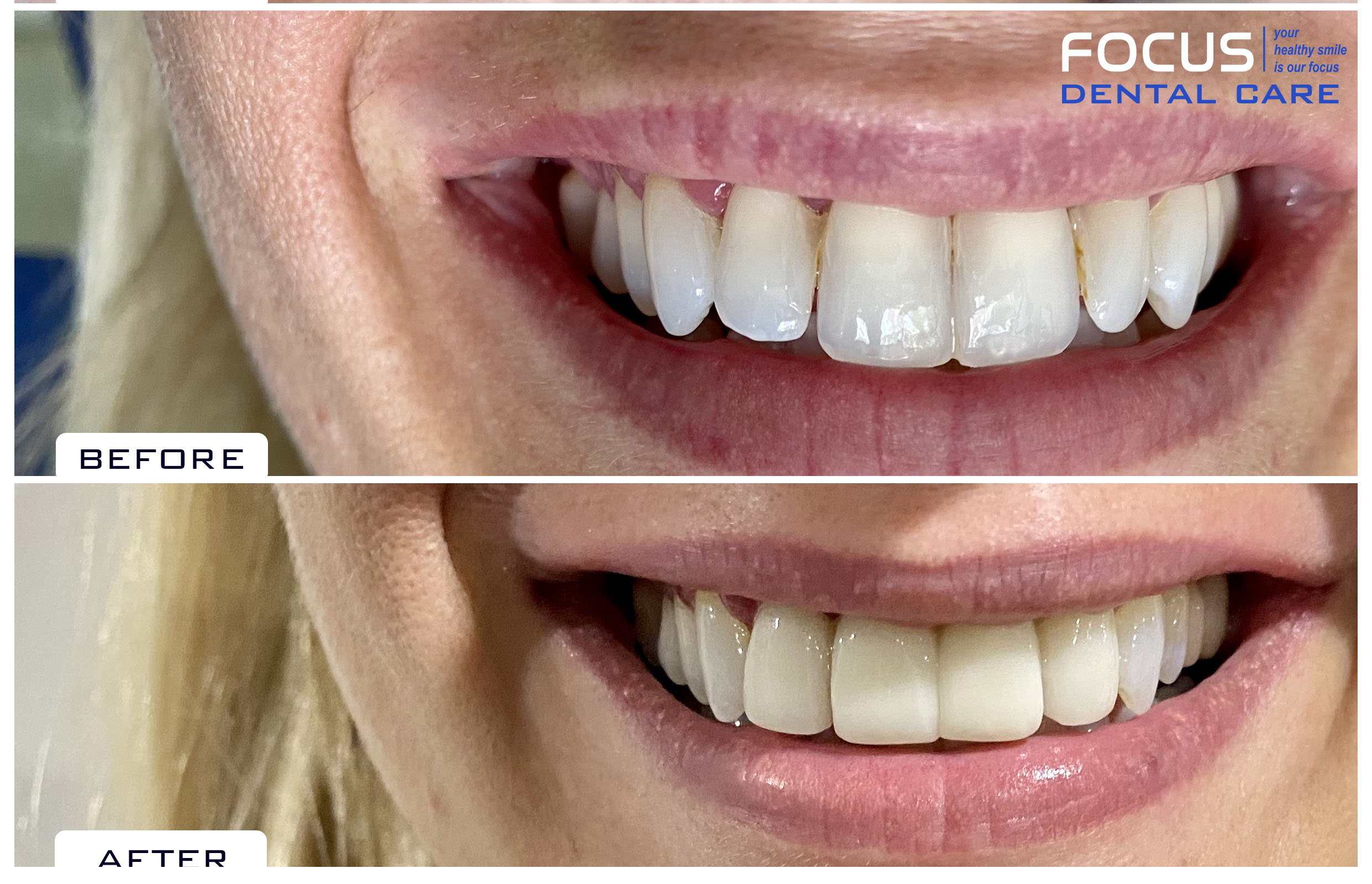 Dental Veneers in Hyderabad