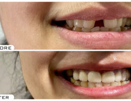 Dental Veneers in Hyderabad