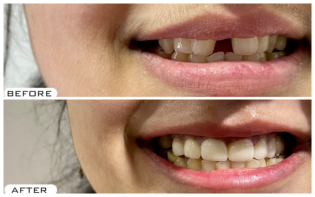 Dental Veneers in Hyderabad