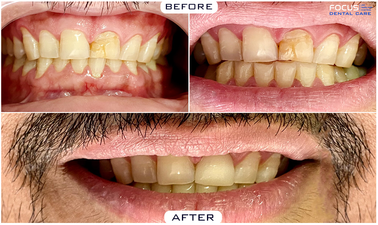 Dental Crowns Cost & Treatment in Hyderabad India Focus Dental Care