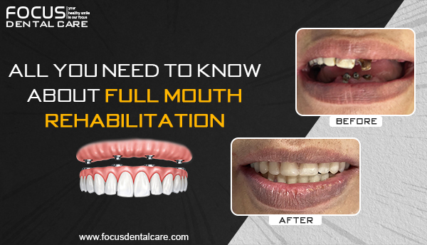 Full Mouth Rehabilitation in Hyderabad