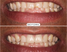 Dental Veneers in Hyderabad