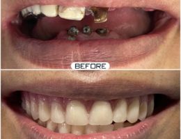 Full Mouth Rehabilitation With Dental Implants in Hyderabad