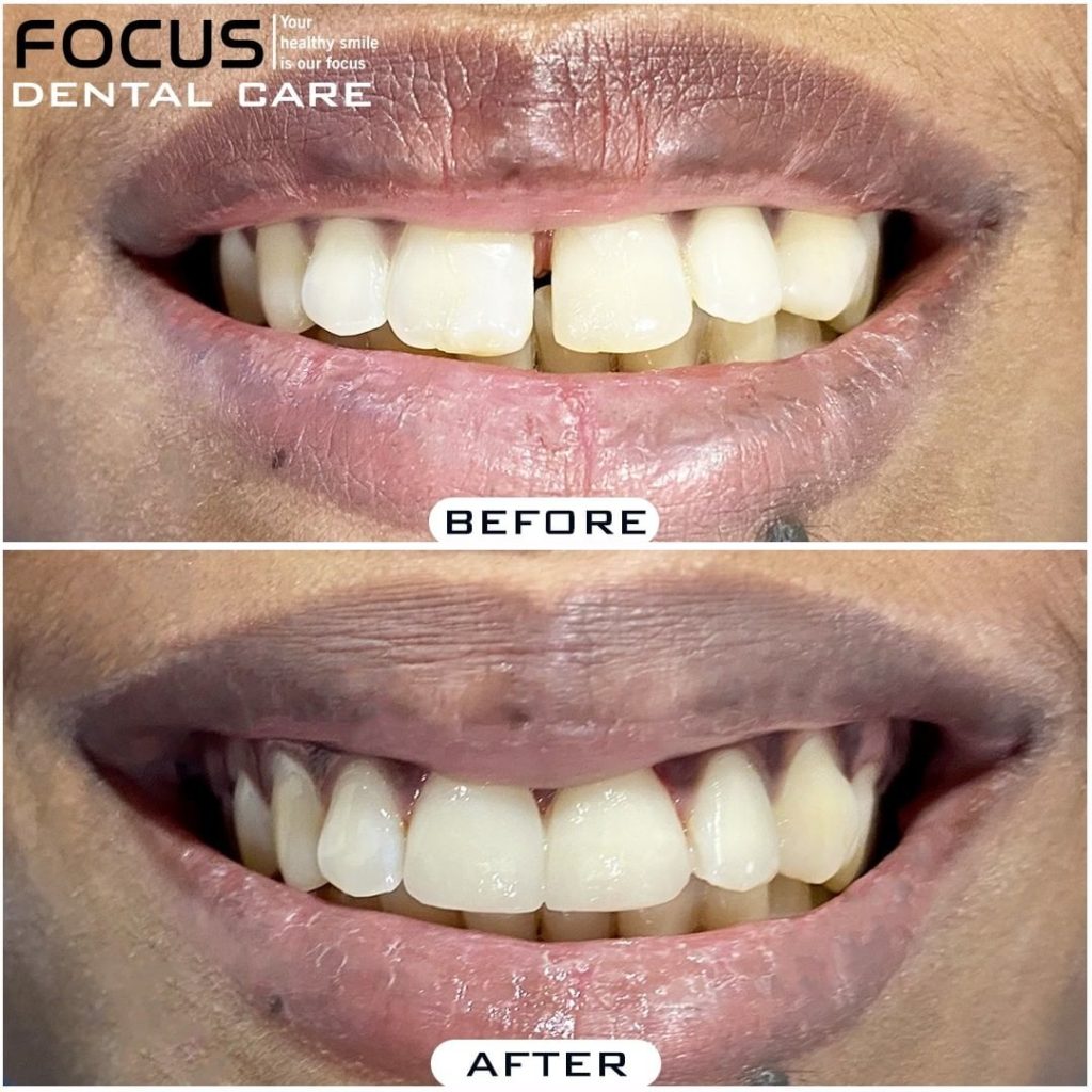 Dental Veneers in Hyderabad