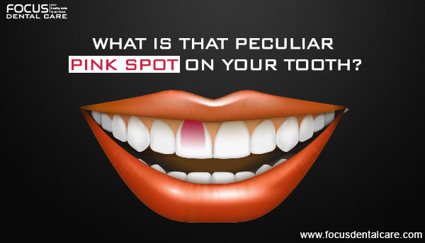 pink tooth treatment in Hyderabad