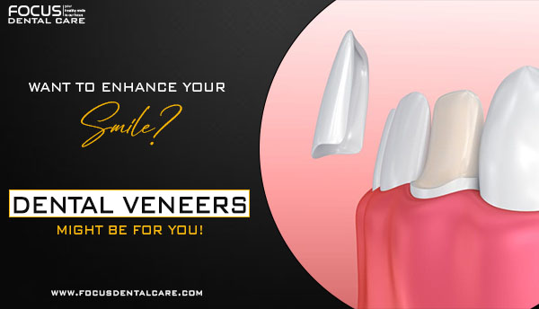 Dental Veneers in Hyderabad