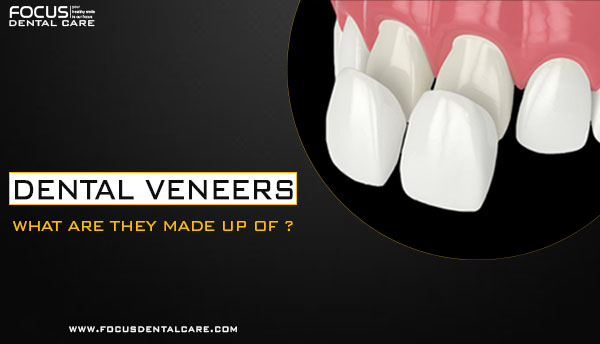 Dental Veneers What are the made up of ?