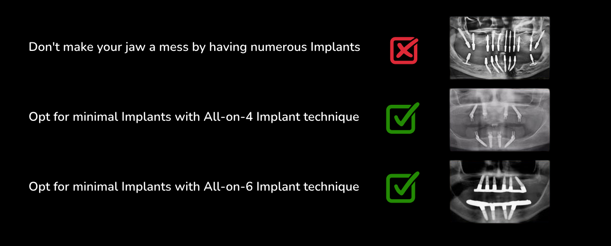 dental-implants-pic